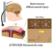 Brain trauma with axon shear, eps8 Brain trauma with axon shear, eps8