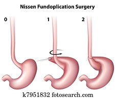 Nissen Fundoplication Surgery, eps8 Nissen Fundoplication Surgery, eps8