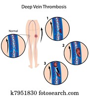 עמוק, ווריד, thrombosis,, eps8