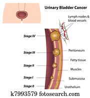 urinário, bexiga, cancer,