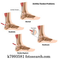 גיד של אכילס, problems,