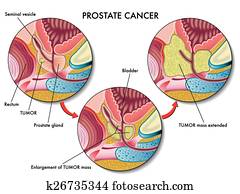 Prostate Cancer Prostate Cancer