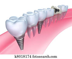 dental, implants, em, a, gengiva