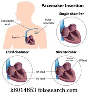 Pacemaker insertion surgery, eps8 Pacemaker insertion surgery, eps8