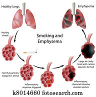 לעשן, ו, emphysema,, eps8