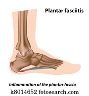 פלאנטאר, fasciitis,, eps8