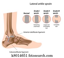 קרסול, הקעה, grading,, eps8