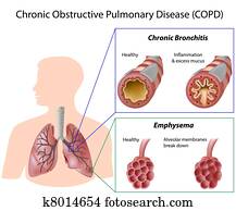 ריאה, disease,, eps8