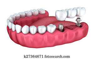 3d lower teeth and dental implant isolated on white 3d lower teeth and dental implant isolated on white