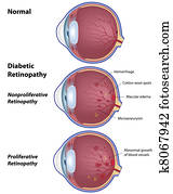 Diabetic retinopathy, eps8 Diabetic retinopathy, eps8