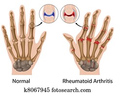 דלקת המפרקים שיגרונית, של, hand,, eps8