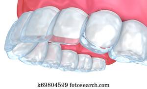 Teeth whitening process. Medically accurate tooth 3D illustration Teeth whitening process. Medically accurate tooth 3D illustration