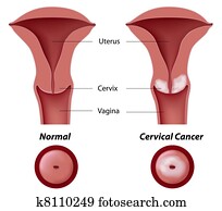 cervical, câncer, eps8