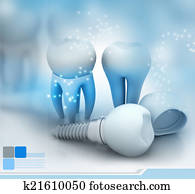 Dental Implant Dental Implant