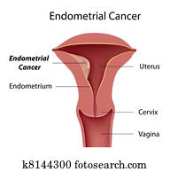 Endometrial, câncer, eps8