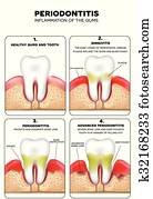 Periodontitis Periodontitis