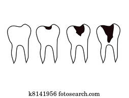 Tooth Decay Tooth Decay