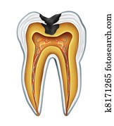 Tooth cavity Tooth cavity