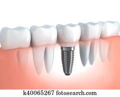 Dental implant Dental implant