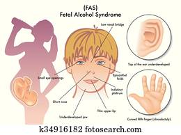 Fetal Alcohol Syndrome Fetal Alcohol Syndrome