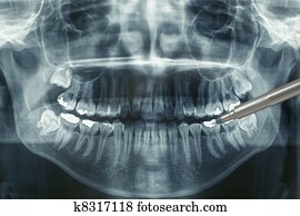 xray dental