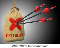 כאלאליטיס, ב, a, לתלות, sack.