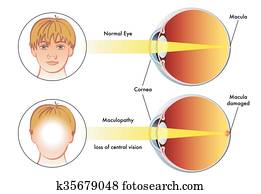 maculopathy maculopathy