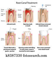 שורש, תעלה, treatment,, eps8