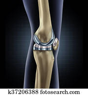 Knee Replacement Knee Replacement