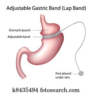 gástrico, faixa, perda peso, cirurgia