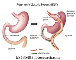 Roux-en-Y Gastric Bypass, eps8 Roux-en-Y Gastric Bypass, eps8