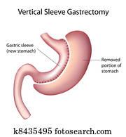 Vertical Sleeve Gastrectomy, eps8 Vertical Sleeve Gastrectomy, eps8