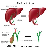 Cholecystectomy, eps8 Cholecystectomy, eps8