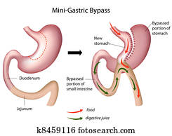 Mini gastric bypass surgery, eps8 Mini gastric bypass surgery, eps8