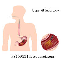 עליון, חייל, endoscopy,, eps8