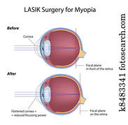Lasik eye surgery for myopia, eps8 Lasik eye surgery for myopia, eps8