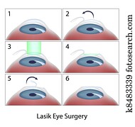 Lasik eye surgery procedure, eps10 Lasik eye surgery procedure, eps10