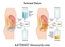peritoneal, diálise