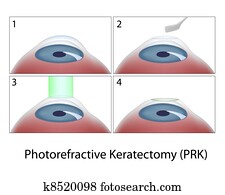 Photorefractive Keratectomy, eps10 Photorefractive Keratectomy, eps10