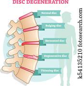 scheibe, degeneration, flache, abbildung, vektor, diagramm scheibe, degeneration, flache, abbildung, vektor, diagramm
