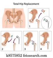 Total hip replacement, eps10 Total hip replacement, eps10