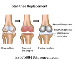 Total knee replacement, eps10 Total knee replacement, eps10
