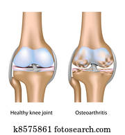 וסטאוארטריטיס, של, ברך, joint,, eps10