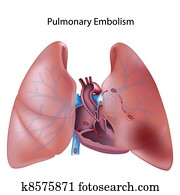 של הריאות, embolism,, eps10