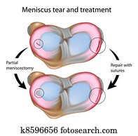 מאניסכאס, קרע, ו, surgery,, eps8