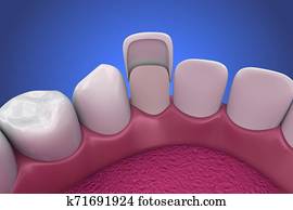 Dental Veneers: Porcelain Veneer installation Procedure. 3D illustration Dental Veneers: Porcelain Veneer installation Procedure. 3D illustration