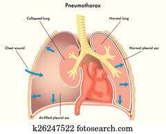 פניאמוטוראקס