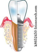 tooth implant tooth implant