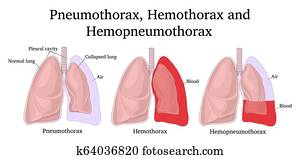 דוגמה, של, pneumothorax,, hemothorax, ו, hemopneumothorax