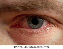 Bloodshot eye Bloodshot eye
